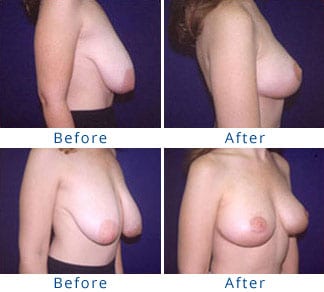 The Three Stages of Breast Sagging