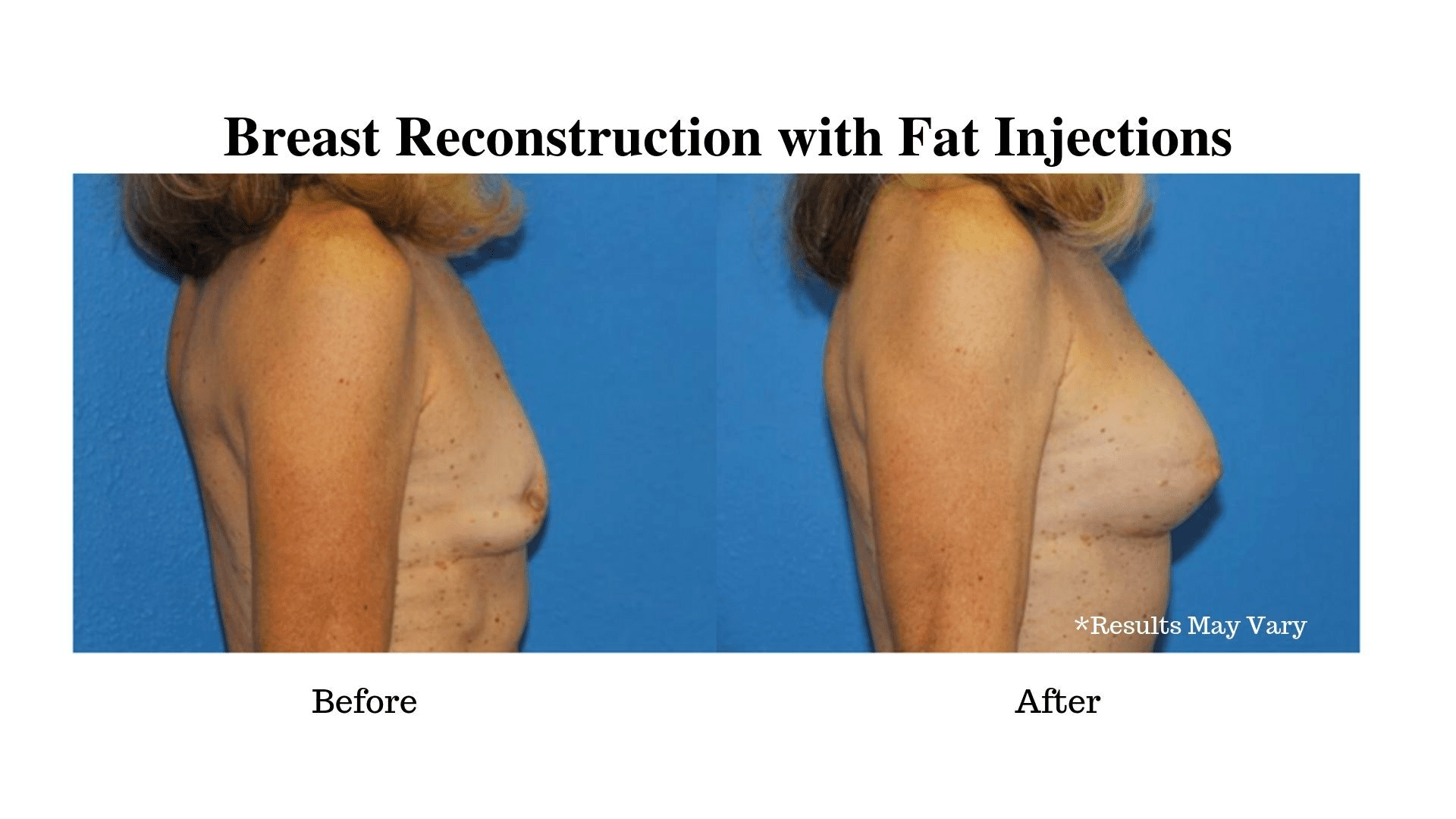 What Are the Benefits of Using Fat Injections for Breast