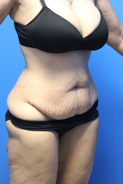 LIPOSUCTION PATIENT 10 View 2 - Before Thumbnail