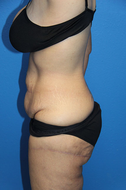 LIPOSUCTION PATIENT 10 View 3 - Before Thumbnail